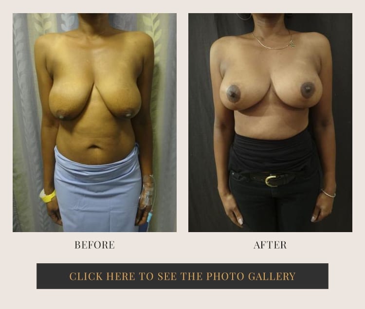 Before and after results of a second breast lift patient