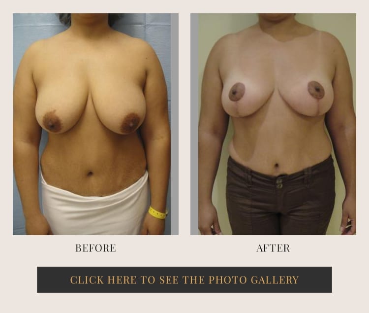 Before and after results of a breast lift