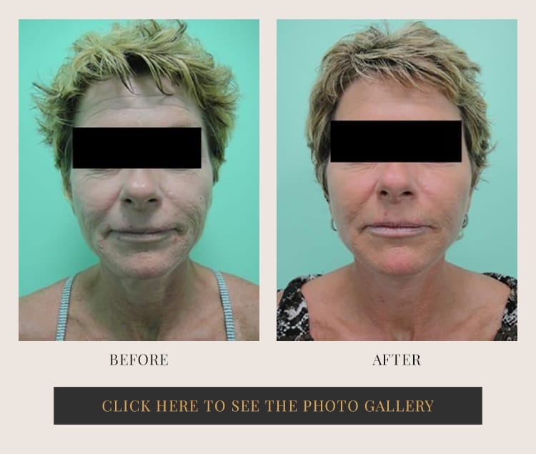 Before and after results for a mini facelift