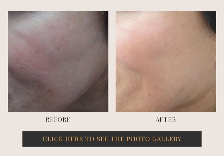 Before and after halo laser treatment - patient 2