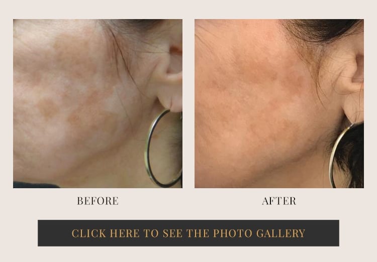 Before and after halo laser treatment - patient 1