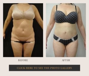 Liposuction in White Plains, New York | Top Rated in Westchester 26
