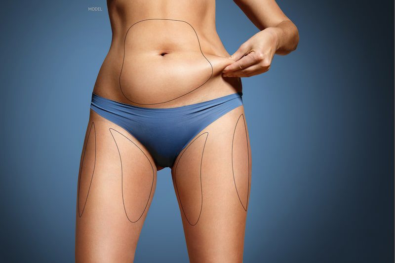 Women pinching some abdominal fat wearing blue undergarments. Body contouring lines drawn on her abdomen and thighs.
