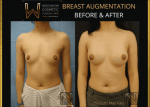 Before and after image showing the results of a breast augmentation performed in Westchester, NY.
